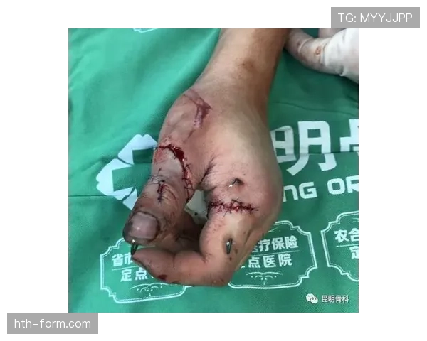 奥布拉克手指伤势恢复缓慢,预计将对球队表现产生深远影响 奥布拉克手指伤势恢复缓慢,预计将对球队表现产生深远影响